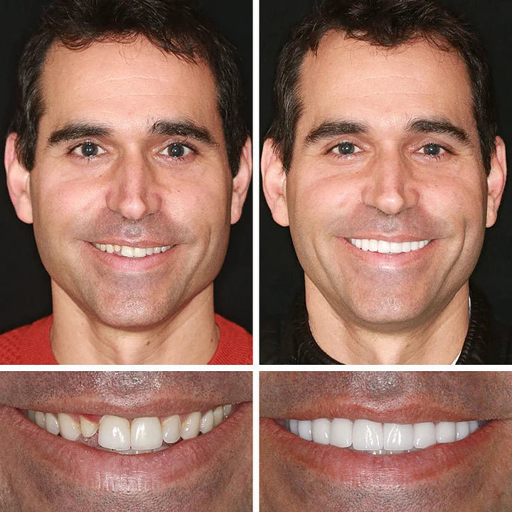 CLINCLII™ --Advanced Customized Full Denture Set🦷