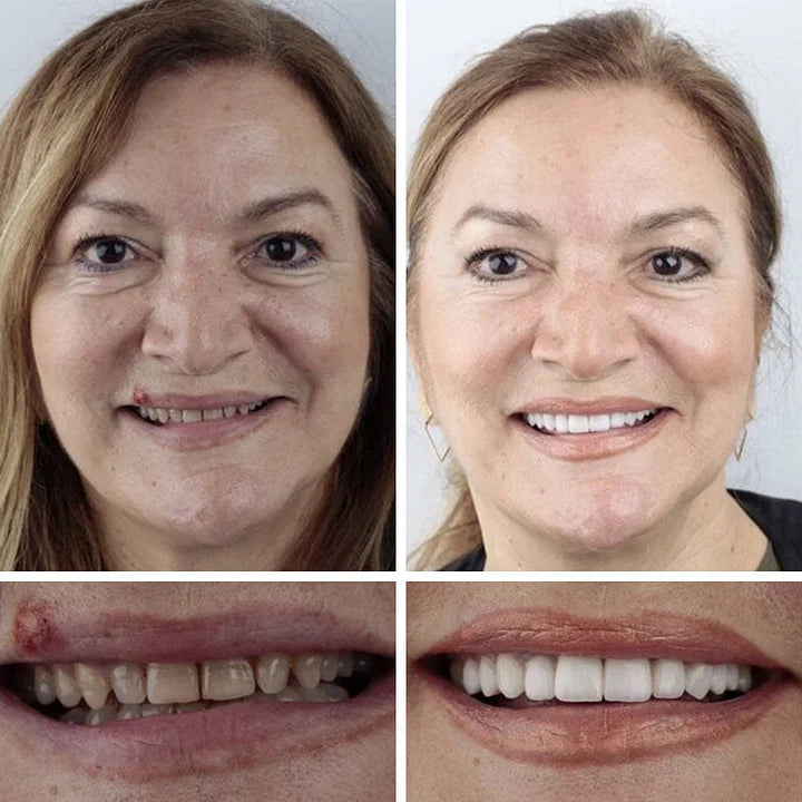 CLINCLII™ --Advanced Customized Full Denture Set🦷