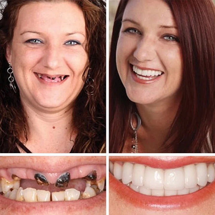 CLINCLII™ --Advanced Customized Full Denture Set🦷