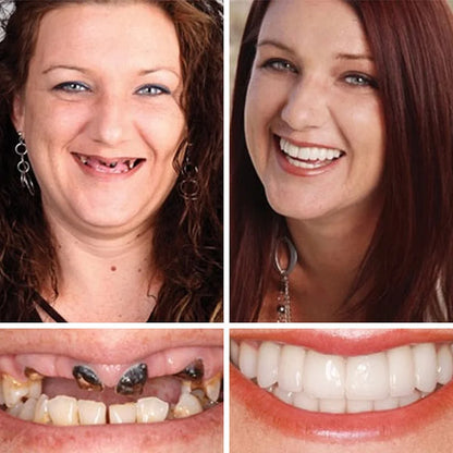 CLINCLII™ --Advanced Customized Full Denture Set🦷
